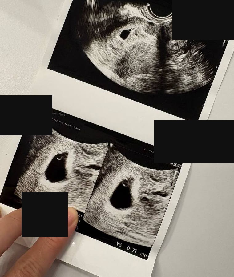 4월 11일 산부인과 첫 초음파에서 아기집을 확인한 공개용 마스킹 기록 사진